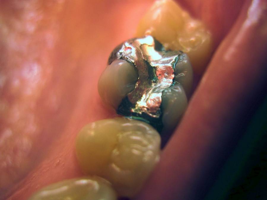 mercure-amalgame-dentaire.jpg